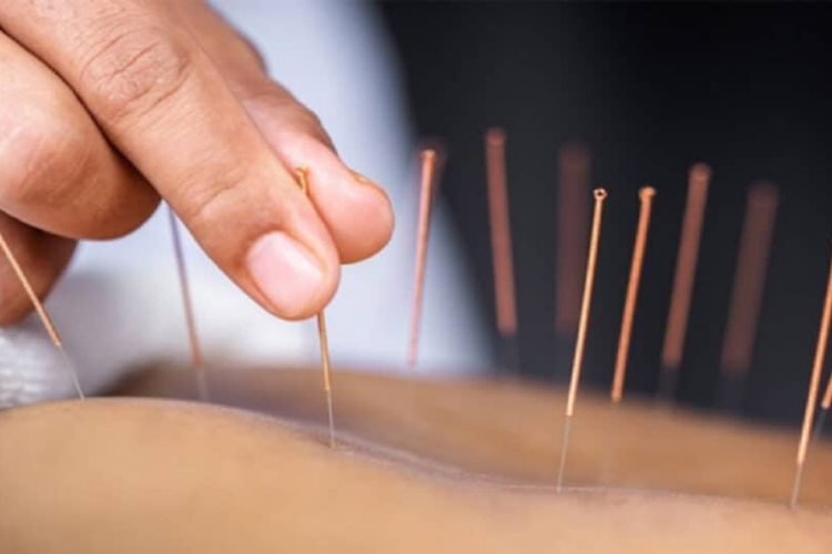 Điện mãng châm điều trị rối loạn tiền mãn kinh